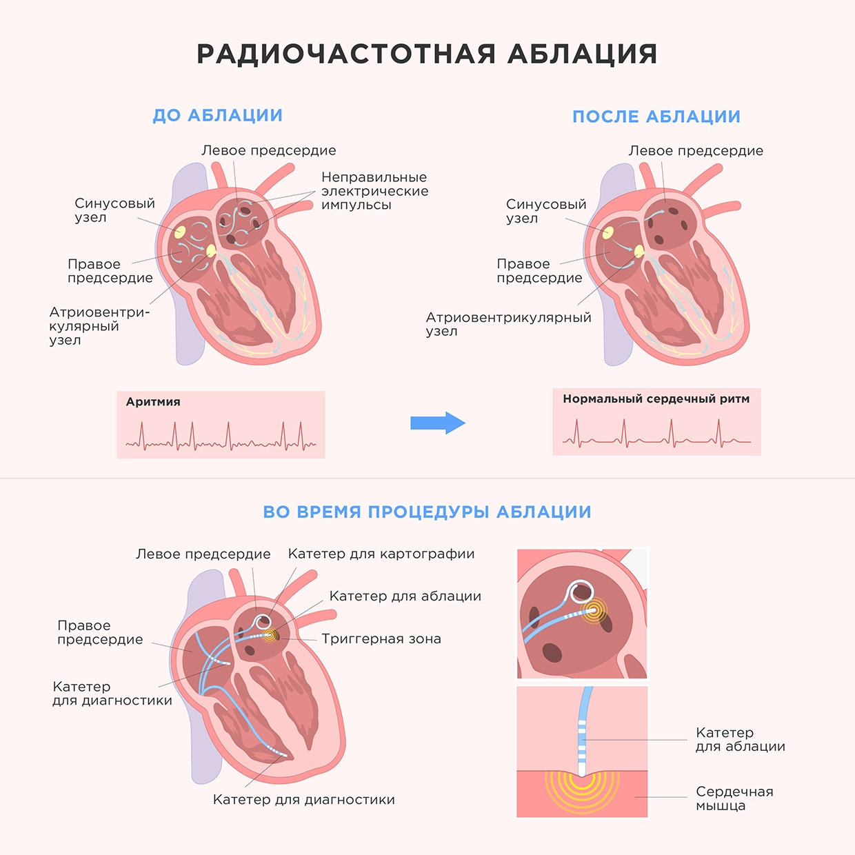 Аритмия сердца – что это такое, и как лечить?